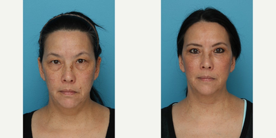 Eyelid Surgery before and after photo