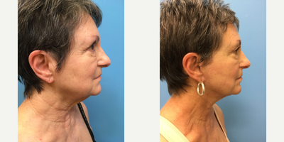 Facelift before and after photo