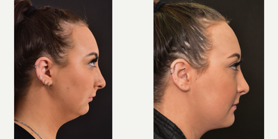 Jaw Surgery before and after photo