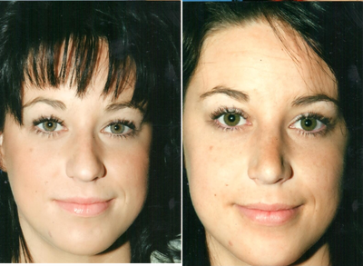 Rhinoplasty before and after photo