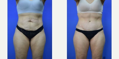Tummy Tuck before and after photo