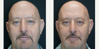 IPL before and after photo