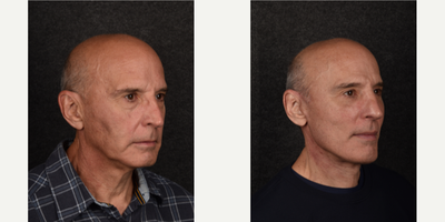Revision Rhinoplasty before and after photo