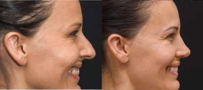 Rhinoplasty before and after photo