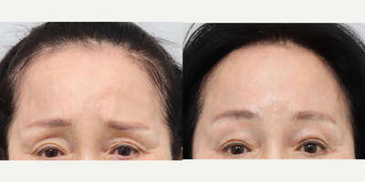 SMAS Facelift before and after photo