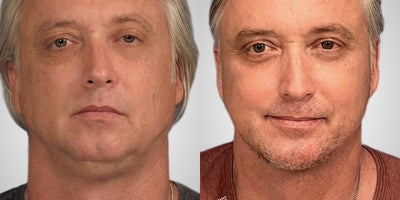 Chin Implant before and after photo