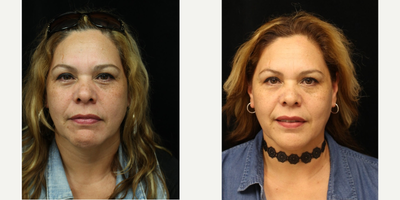 Dermal Fillers before and after photo