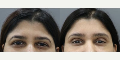 Eyelid Surgery before and after photo
