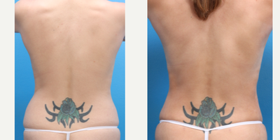 Liposuction before and after photo