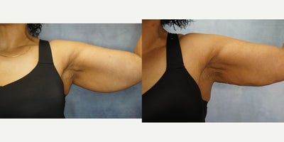 Liposuction before and after photo