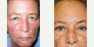 Ptosis Surgery before and after photo