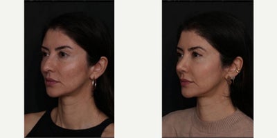Rhinoplasty before and after photo