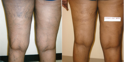 Sclerotherapy before and after photo