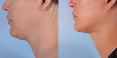Chin Liposuction before and after photo