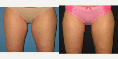 CoolSculpting before and after photo