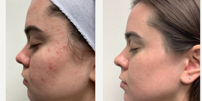 Halo Laser before and after photo