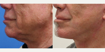 Lower Facelift before and after photo