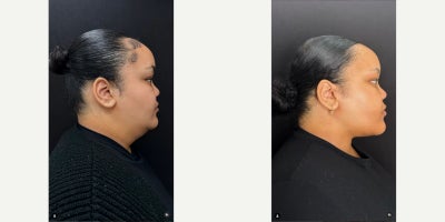 Renuvion before and after photo