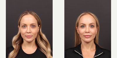 Brow Lift before and after photo