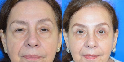 Eyelid Surgery before and after photo