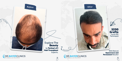FUE Hair Transplant before and after photo