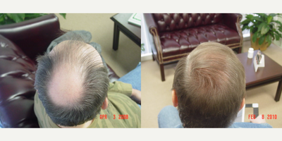 Hair Transplant before and after photo