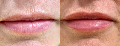 Lip Fillers before and after photo