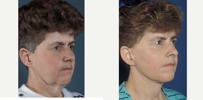 Lower Facelift before and after photo