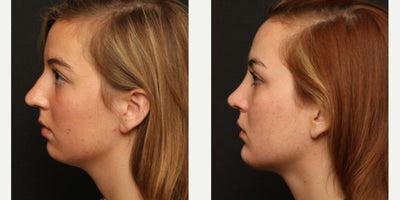 Rhinoplasty before and after photo