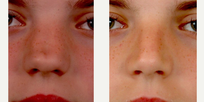 Septoplasty before and after photo