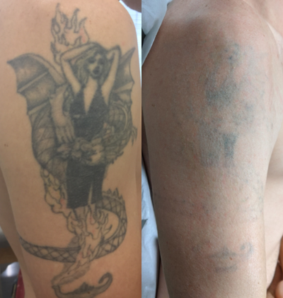 Tattoo Removal before and after photo