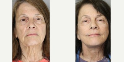 Facelift before and after photo