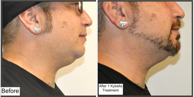 Kybella before and after photo