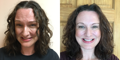 Botox before and after photo