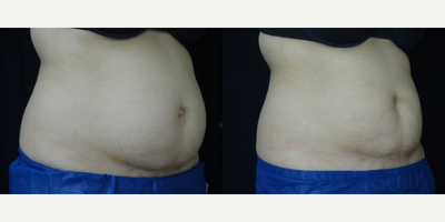 CoolSculpting before and after photo