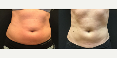 CoolSculpting before and after photo