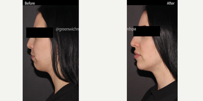 Dermal Fillers before and after photo
