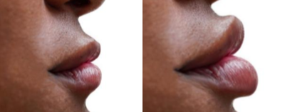 Dermal Fillers before and after photo