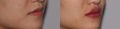 Dermal Fillers before and after photo