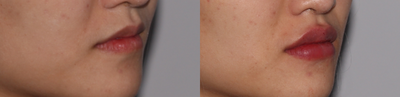 Dermal Fillers before and after photo