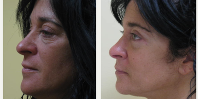 Eyelid Surgery before and after photo