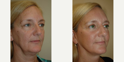 Eyelid Surgery before and after photo