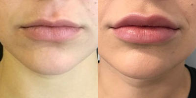 Juvederm before and after photo