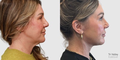 Neck Lift before and after photo