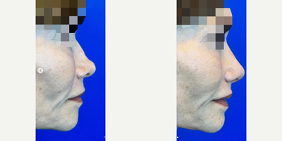 Revision Rhinoplasty before and after photo