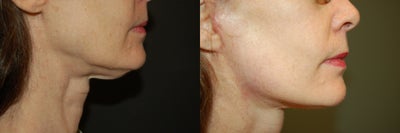 Chin Liposuction before and after photo