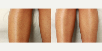 Venus Legacy before and after photo