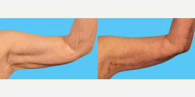 Arm Lift before and after photo