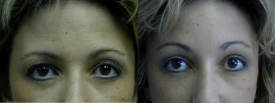 Brow Lift before and after photo