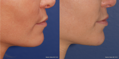Chin Implant before and after photo